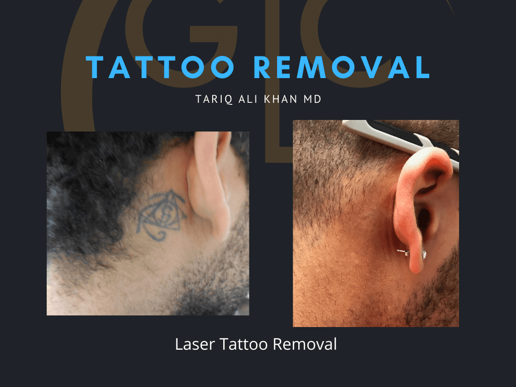 Gentle Care Laser Tustin & Long Beach CA Before and After picture - Tattoo Removal